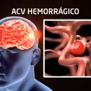 Realizarán una caminata para prevenir el ACV: los detalles