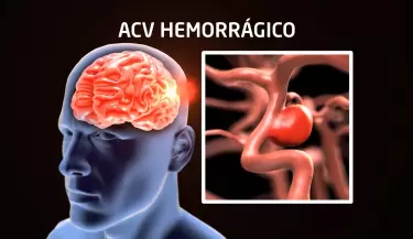 acv