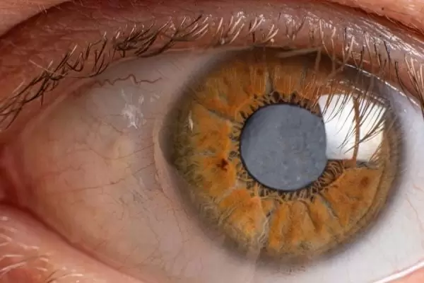 glaucoma