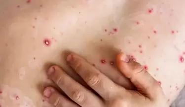viruela