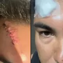 El fuerte descargo de un hincha del Tomba, tras los disturbios con la policía: "Terminé en urgencias"