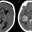 Qué es el linfoma cerebral, el tipo de cáncer que enfrenta Raphael