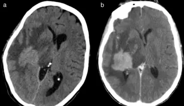 Linfoma cerebral