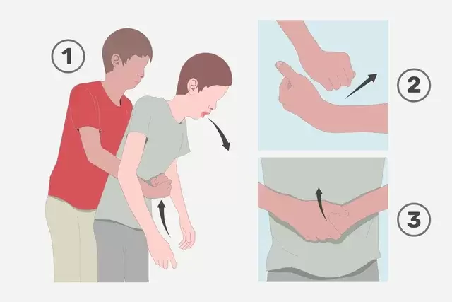 Maniobra de Heimlich