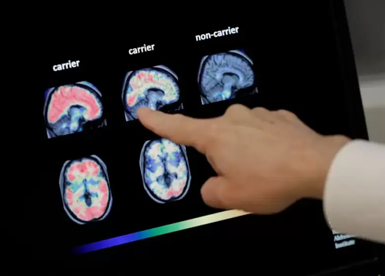 Alzheimer