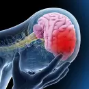 Aumento preocupante de accidentes cerebrovasculares en adultos jóvenes y mujeres: posibles causas