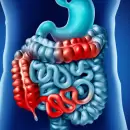 El impacto silencioso de las enfermedades intestinales en la poblaci�n joven