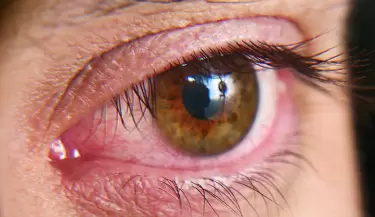 Ojo seco en invierno: s�ntomas, causas y claves para cuidar tu vista
