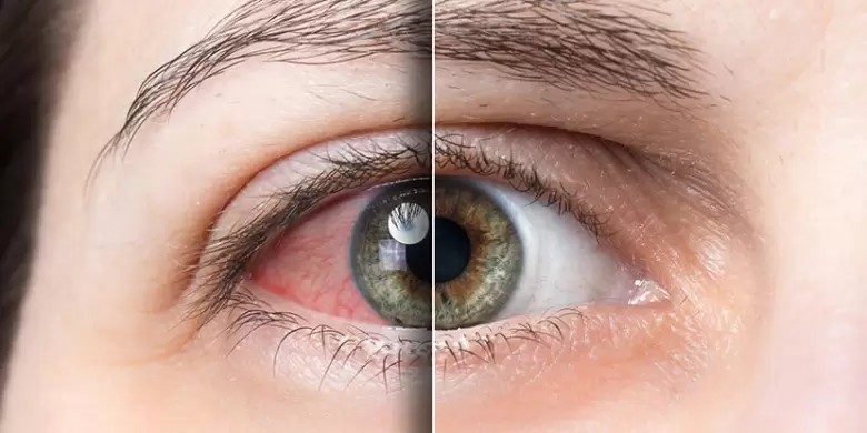 Ojo seco