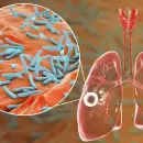Tuberculosis en baja: Mendoza alcanza una incidencia histórica, mientras aumentan los casos en el país