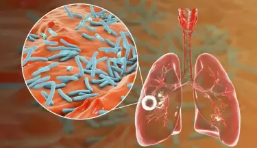 tuberculosis