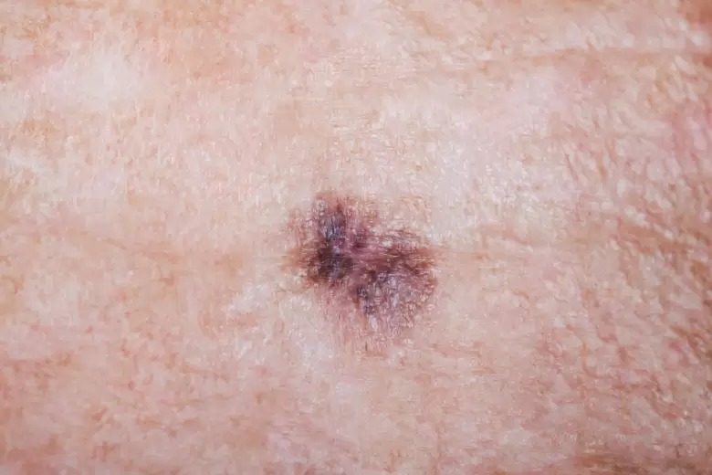VACCINEL