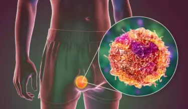 c�ncer testicular