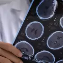 En Mendoza estiman que hasta 700 personas conviven con esclerosis múltiple