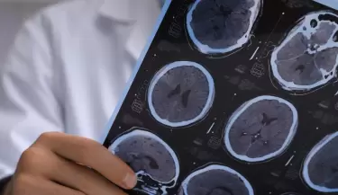 esclerosis multiple